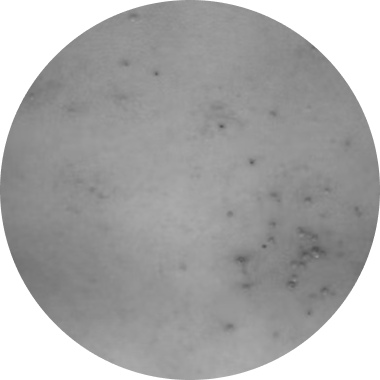 Treatment of Molluscum Contagiosum