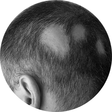 Autoimmune Hair Loss